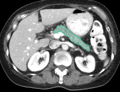 The same slice with the pancreas outlined in green