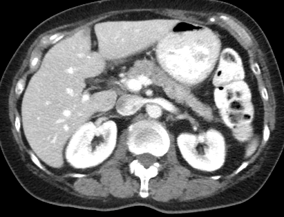 A CT slice of the abdomen